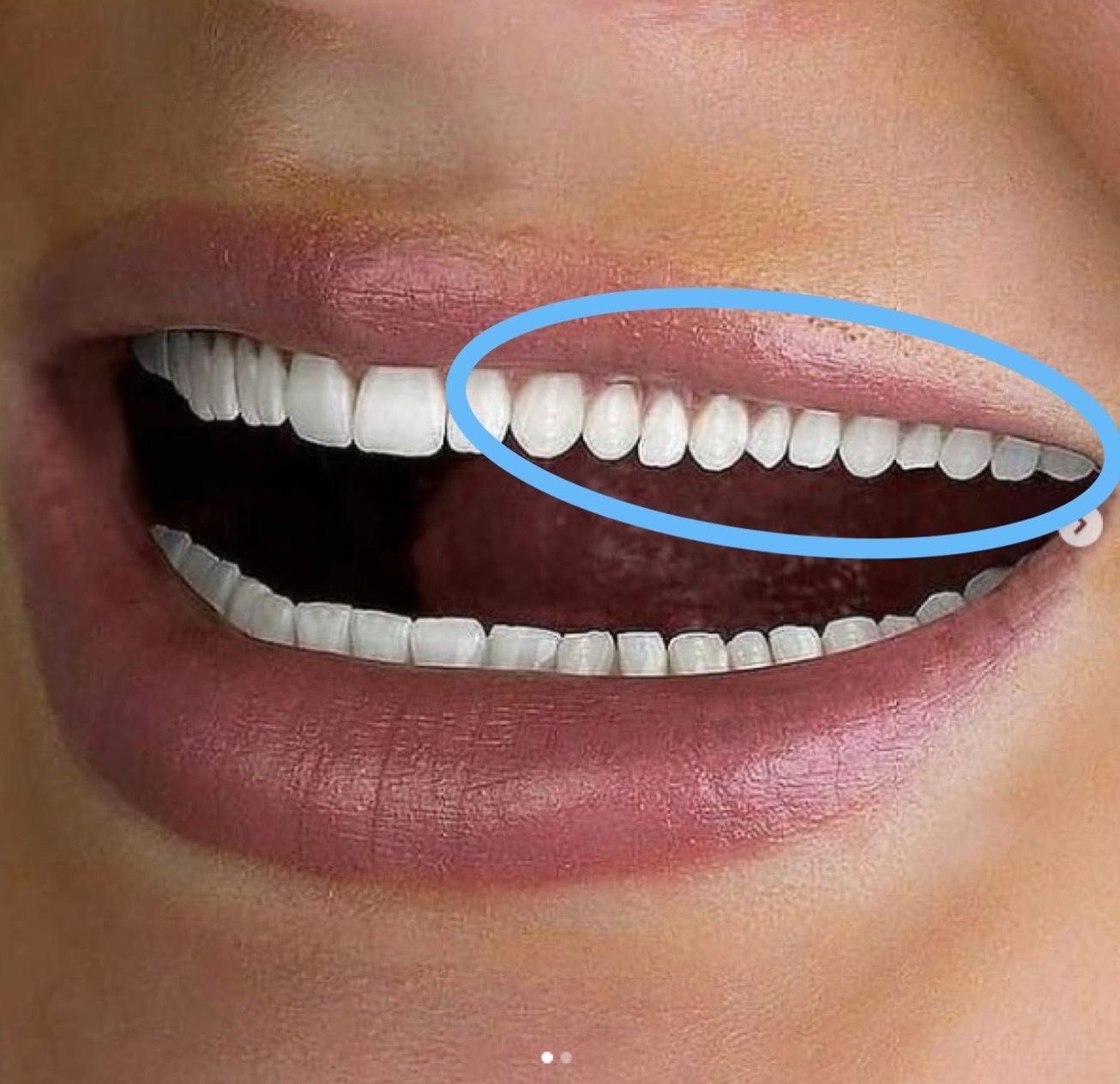 Close-up of mouth with Photoshop fail showing an extra row of teeth, emphasizing editing mistake.