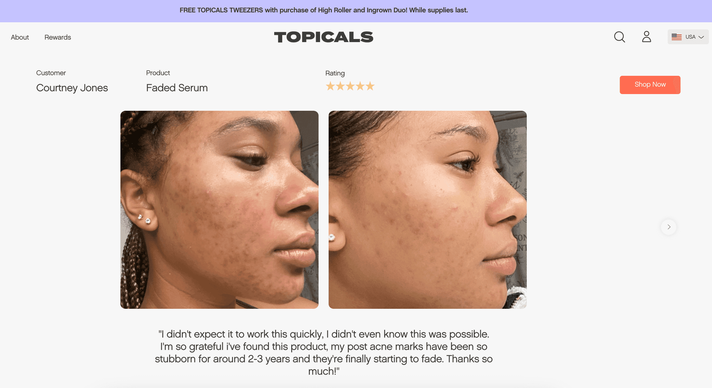 Before and after images of acne scar reduction using Topicals Faded Serum, showing visible skin improvement.